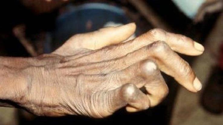 Shimla: National leprosy eradication program being run for leprosy patients in the state