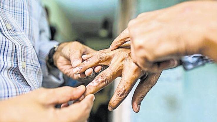 Leprosy Rehabilitation Scheme is creating positivity in leprosy patients