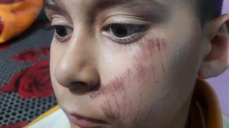 child fell in school time; Accidents came, case registered