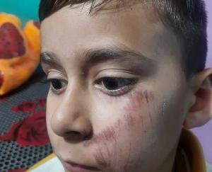 child fell in school time; Accidents came, case registered